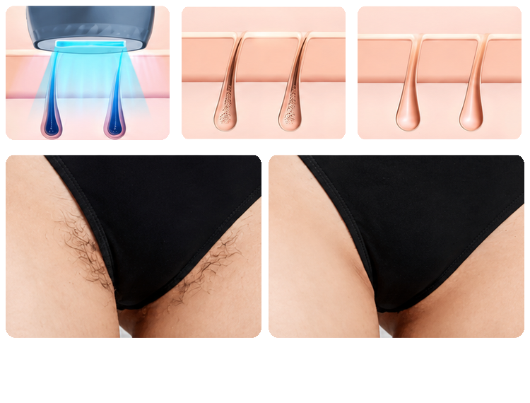 Acts on the hair follicle root to inhibit growth